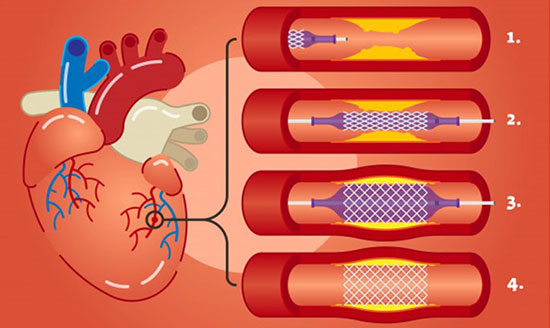 CORONARY ANGIOPLASTY IN KALYAN